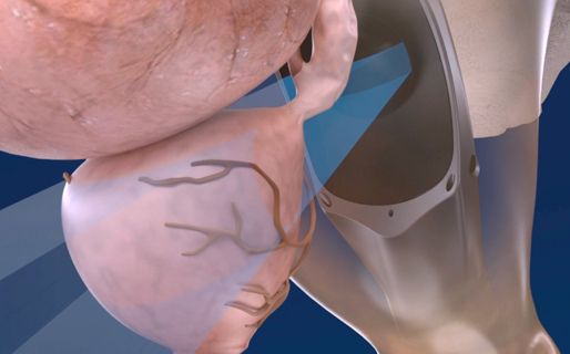 Focal Therapy in Prostate Cancer Management | Focal One