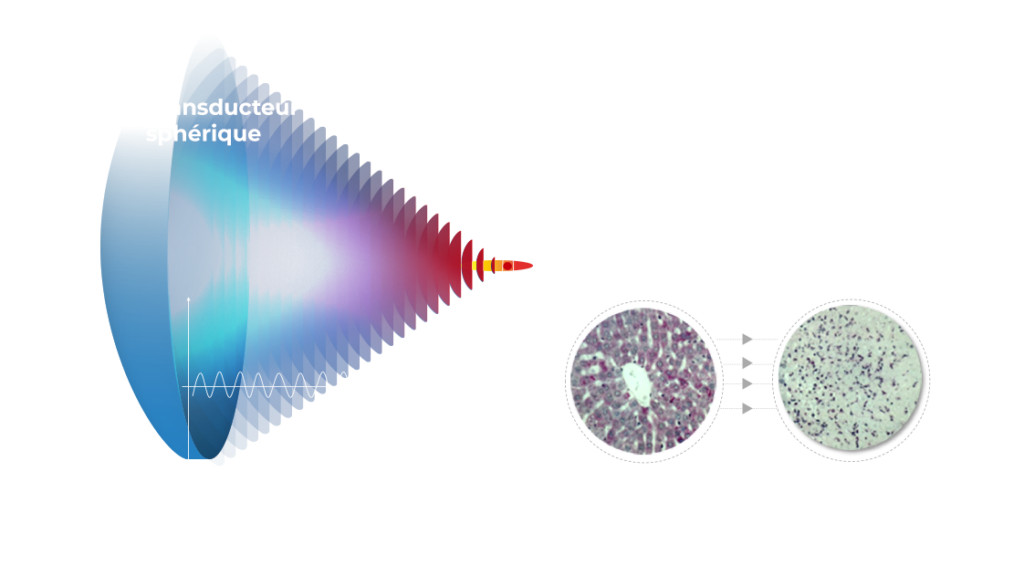 Principe de l'HIFU