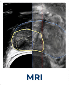FocalOne_with_MRI