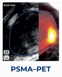 FocalOne_with_PSMA-PET