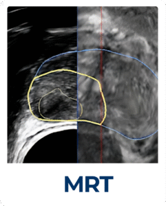 FocalOne_with_MRI-DE