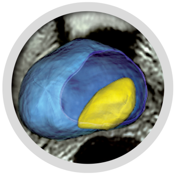 Focal One HIFU system's HIFUsion portal interface showing real-time imaging and treatment options for prostate tissue ablation.